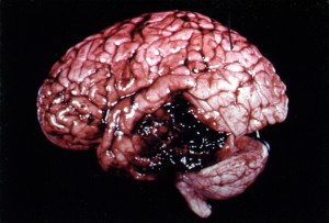 Lesión por hematoma en el cerebro.
