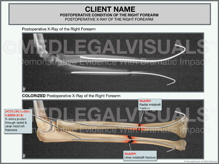 Forearm Fracture Types