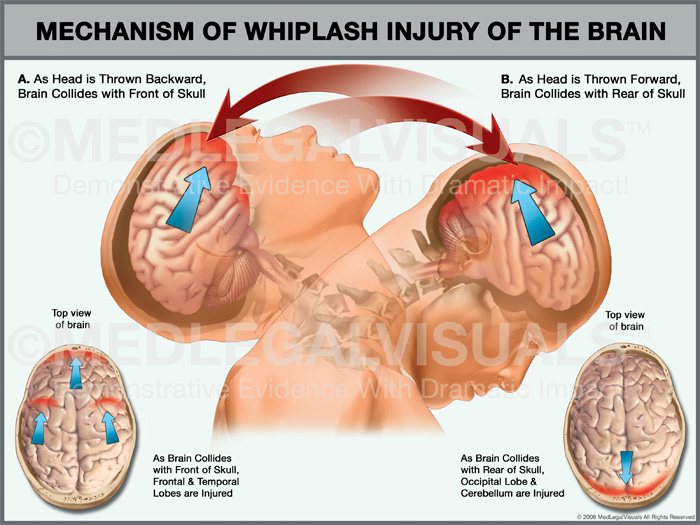 Whiplash Causes And Recovery After An Auto Accident Premier Law