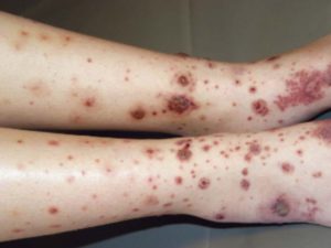 Disseminated Purpuric Lesions causing hematoma injuries