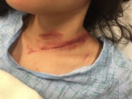 seatbelt neck injury caused by an auto accident