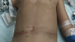 seatbelt bruise on stomach after car crash