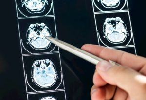 brain injury seizure scan
