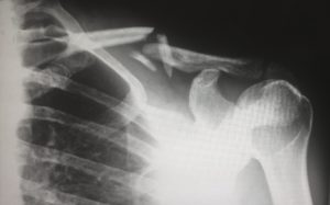 car accident shoulder injury lawyers in Seattle Bellevue Renton and Federal Way