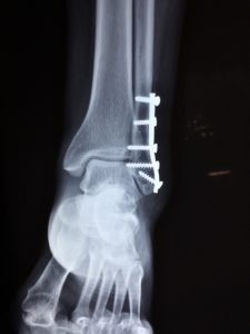 Abogados de lesiones de tobillo roto en Seattle Renton Bellevue y Federal Way