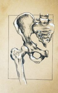 Diagrama de lesión de cadera rota