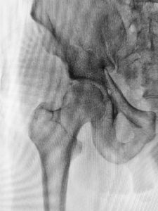 radiografía de fractura de cadera