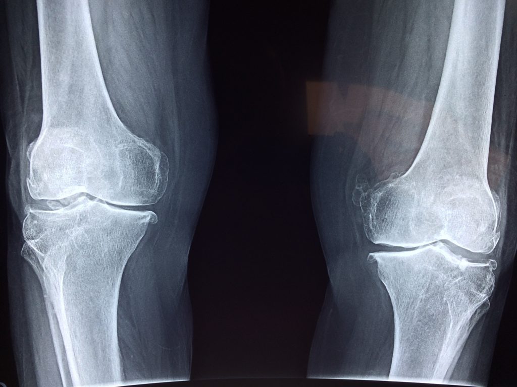 Imagen de rayos X de una lesión en la rodilla.