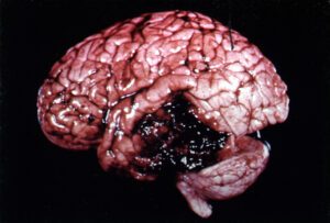 Hematoma injury on the brain